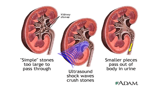 Lithotripsy